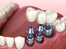 illustration of implants being placed in mouth next to natural teeth, dental implants Marlboro, NJ implant dentist