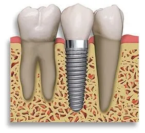 Dental Implant Restoration Hunt Valley, MD