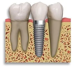 Dental Implant Restoration Hunt Valley, MD