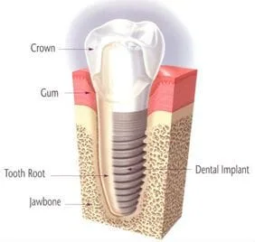 cosmetic-dental-implant_Boogren