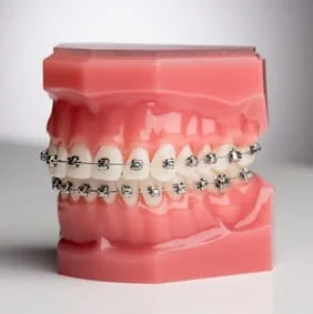 plastic model of teeth with metal braces on them, best orthodontist in Fairfax, VA