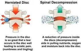 Fairfax Chiropractor | Fairfax chiropractic What is spinal decompression? |  VA |