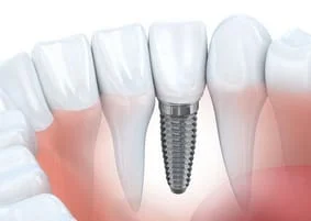 dental implant embedded into jaw next to natural teeth, dental implant dentist Boca Raton, FL implant dentistry