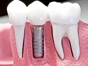3D model of dental implant embedded into mouth with natural teeth, cosmetic dentist Los Angeles, CA