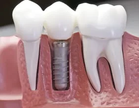 model showing teeth and roots in gums with embedded implant, dental implant restoration Leesburg, VA dentist