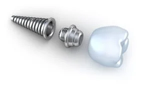Dental Implants Wilsonville OR | Dentist