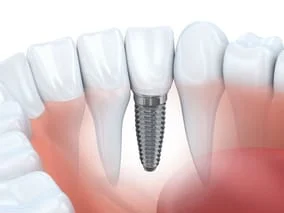 illustration of dental implant embedded into jaw with natural teeth, dental implants Plantation, FL implant dentistry