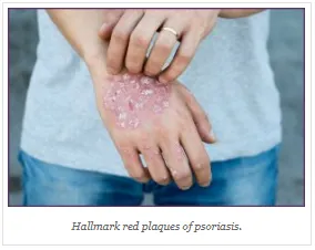Hallmark red plaques of psoriasis