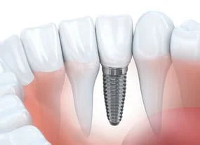 illustration of dental implant in jaw with natural teeth, implant dentistry Huntsville, AL dental implants
