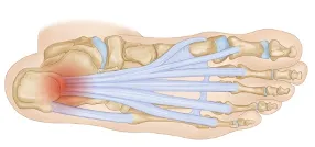 plantar fasciitis foot pain