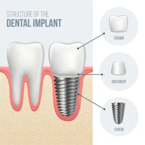 Illustration of Dental Implants Structure, Brownsville, TX