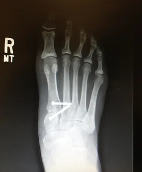 Revisional base bunion correction from another doctor. Corrected with bone graft, screws and k-wires since removed.