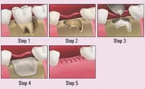 Bone graft diagram