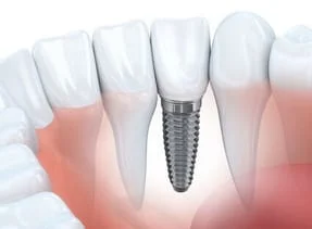 illustration of dental implant embedded in jaw next to natural teeth, dental implants Murrieta, CA implant dentistry