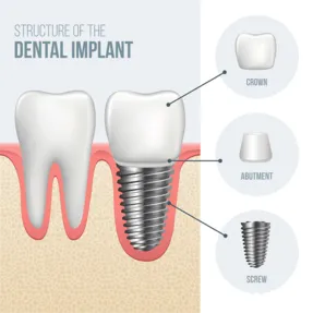 Illustration of anatomy of Dental Implants