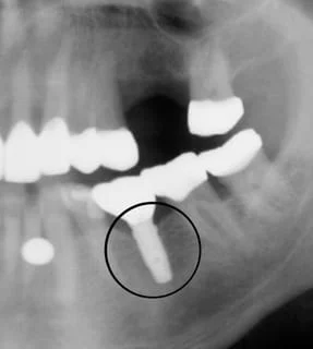 Implant X-Ray | Dental office in Reston, VA