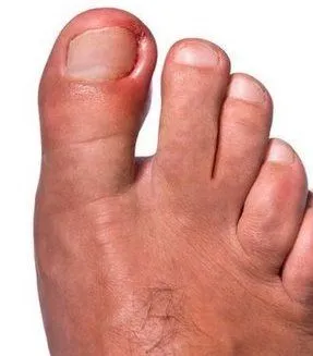 Avenel Podiatrist | Avenel Ingrown Toenails | | Family Podiatry Center |