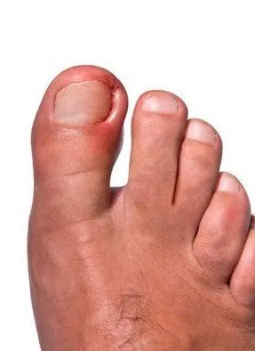 Los Angeles Podiatrist | Los Angeles Ingrown Toenails | CA | Arkady Kaplansky |