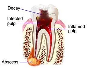 how to relieve your tooth pain with endodontics or root canals