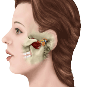 Cartoon illustrating movement of jawbone, TMJ treatment Fairfax, VA