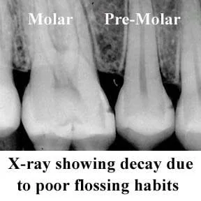 How to Read X Rays - Dentist In Phoenix, AZ