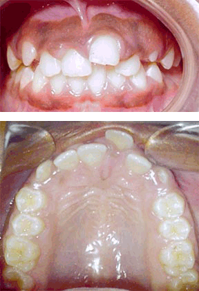 Orthodontic Before