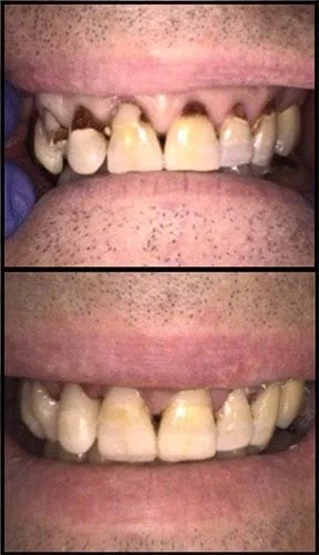 Teeth repair - before and after