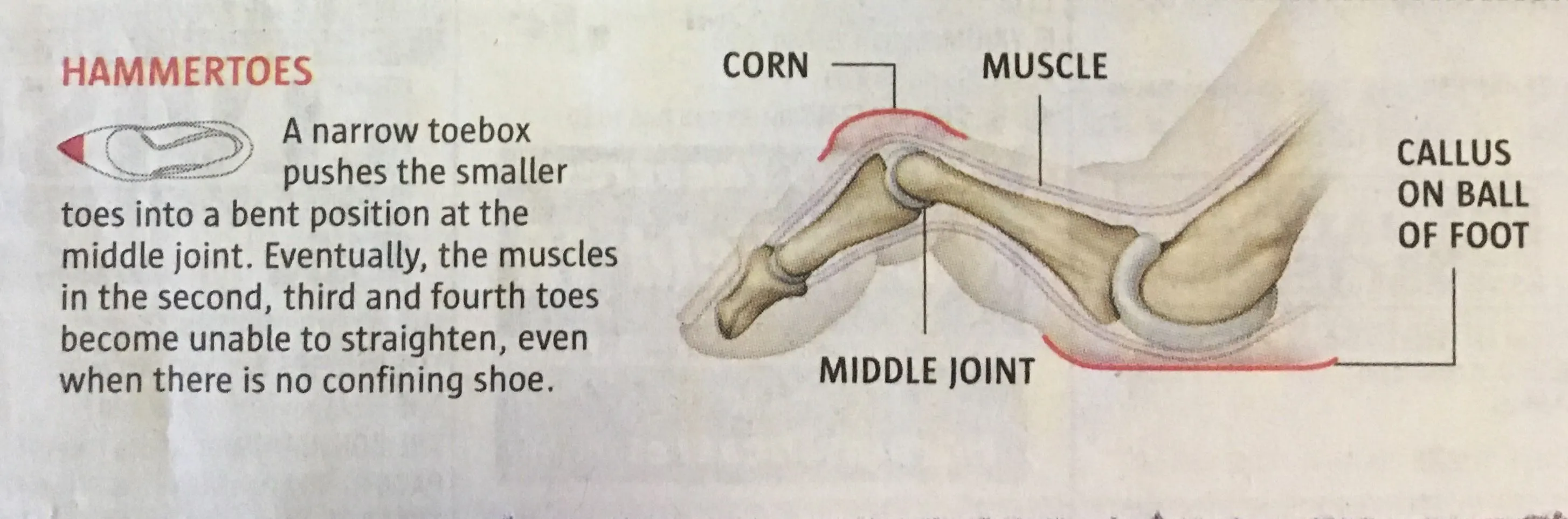 Hammertoe