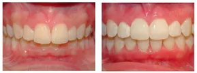 Invisalign trasformation Finksburg, MD