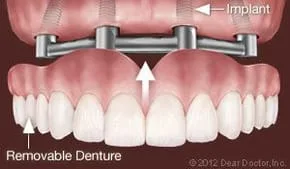 Ann Arbor Dental Implants Support Removable Dentures.