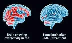 EMDR