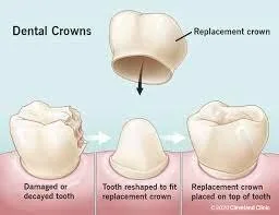 illustration of dental crown covering tooth, Cedar Park, TX crown dentist