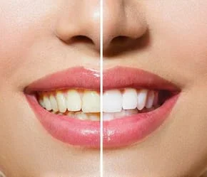 before and after image of woman's teeth, left half yellowed teeth, right half shows results after professional teeth whitening Katonah, NY