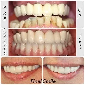 FAILING DENTITION ON UPPER AND LOWER ARCHES
