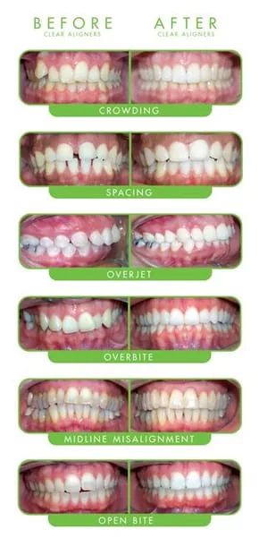 ClearCorrect Before and After