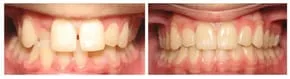 Invisalign dental transformation in Finksburg, MD