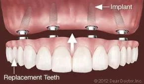 Ann Arbor Dental Implants Replace All Teeth.