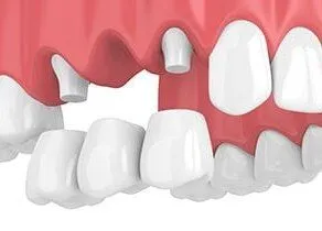 3D illustration of upper teeth in mouth, dental bridge replacing missing tooth, dentist Boca Raton, FL dental bridge