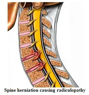 Bad Posture Causes Arthritis?!?!: Advanced Back & Neck Pain Center:  Chiropractic