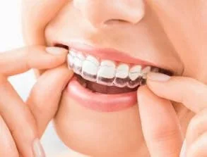 Invisalign aligners in mouth