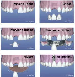 implant-alternatives