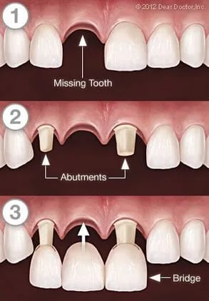 illustration showing three steps of bridge and crowns replacing missing teeth, dental crowns Lincoln, NE 