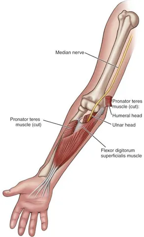 Pronator Teres Syndrome-hidden cause of hand or finger tingling