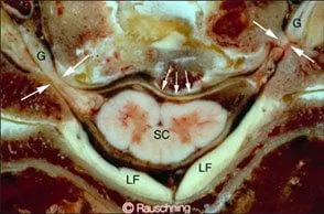 Herniated Disc Dallas  Slipped Disc Injury Southlake