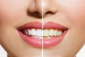 teeth whitening before and after example 