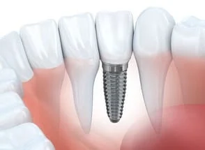computer illustration of dental implant embedded into gums next to natural teeth, dental implants San Marcos, CA implant dentistry