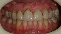 Adelaide close up of woman's mouth showing teeth before dental veneers Cumberland Park, SA