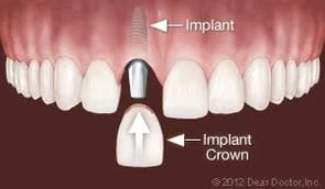 Dental Implants Replace One Tooth Ann Arbor MI