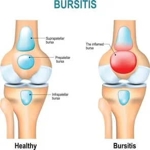 Medical illustration of a knee bursitis