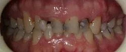 man's mouth close up showing teeth discolored, decayed, damaged before smile makeover at cosmetic dentist Cumberland Park, SA 
